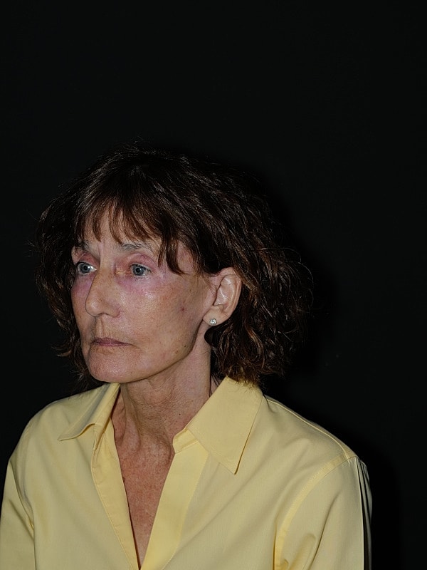 Facelift Neck Lift Before & After