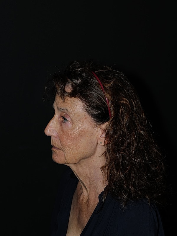 Facelift Neck Lift Before & After