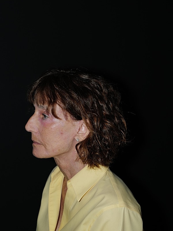 Facelift Neck Lift Before & After