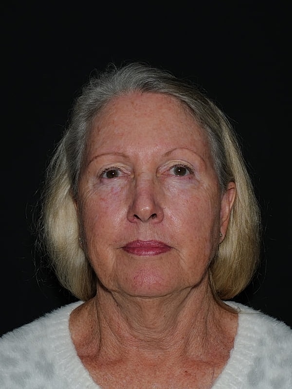 Facelift Neck Lift Before & After