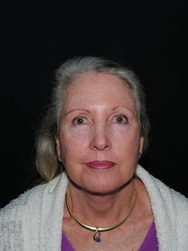 Facelift Neck Lift Before & After