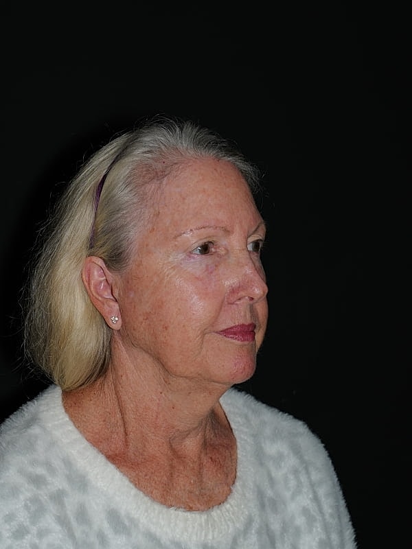 Facelift Neck Lift Before & After