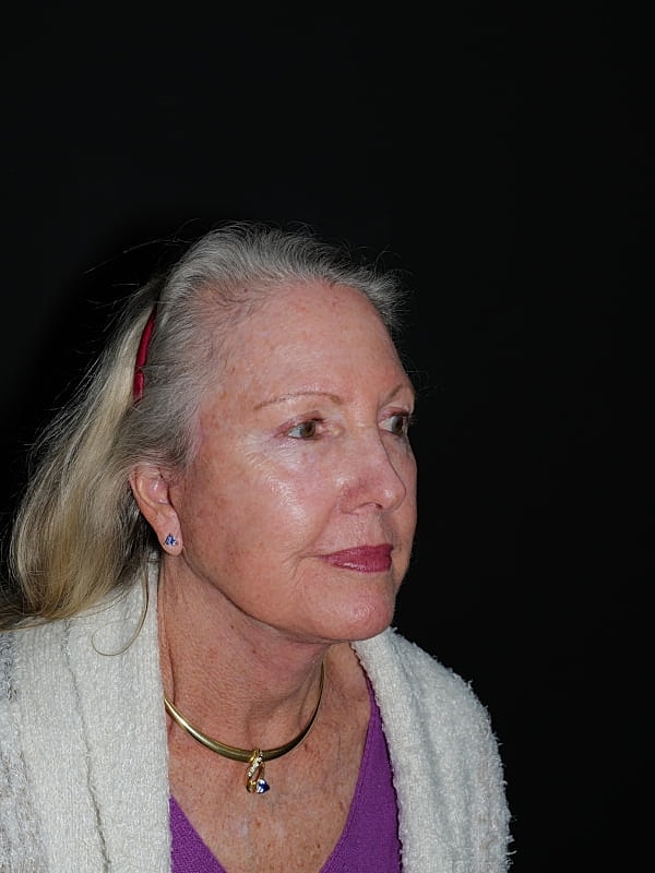 Facelift Neck Lift Before & After