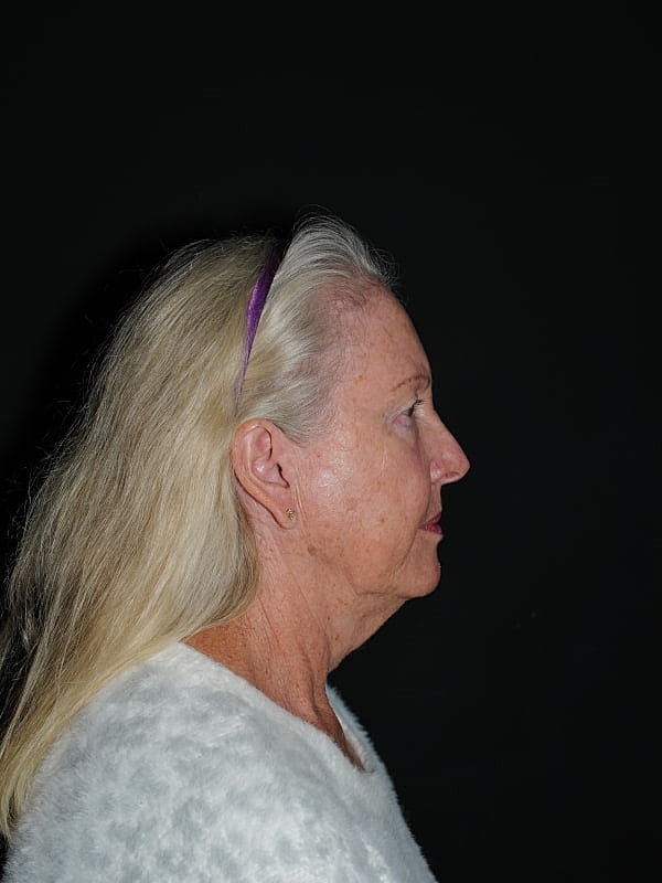 Facelift Neck Lift Before & After