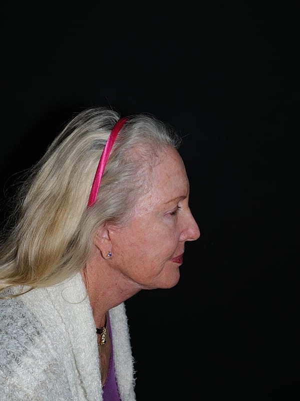 Facelift Neck Lift Before & After