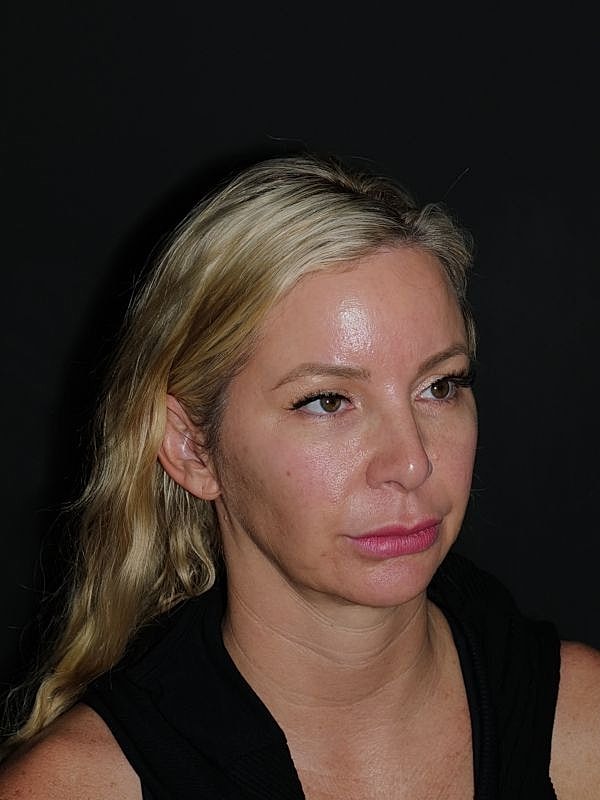 Facelift & Neck Lift Before & After