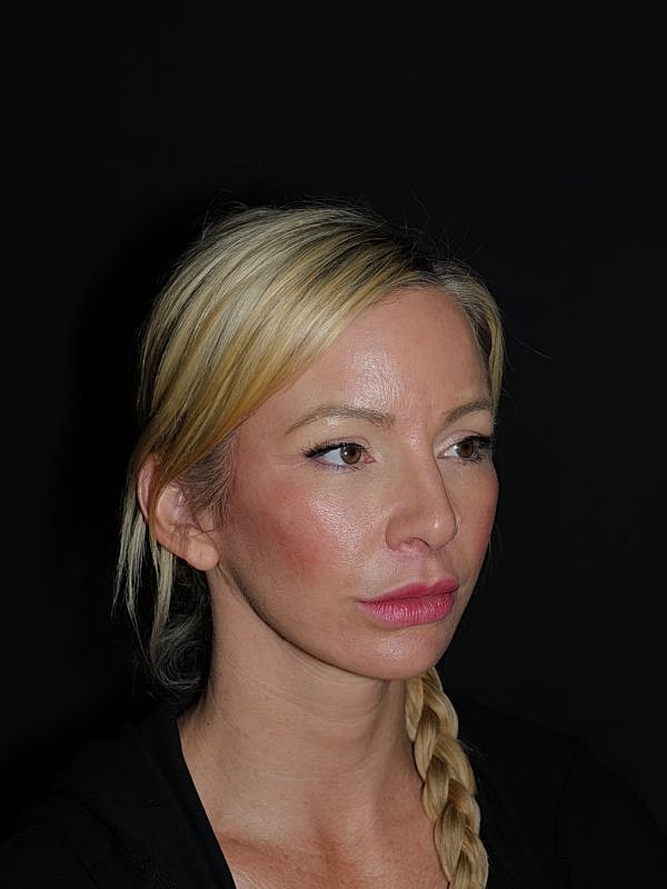 Facelift & Neck Lift Before & After