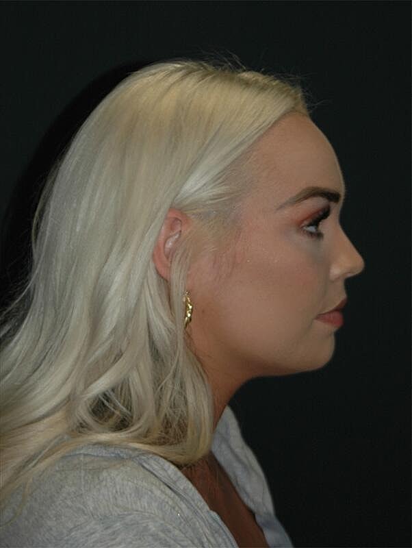 Facelift Before & After