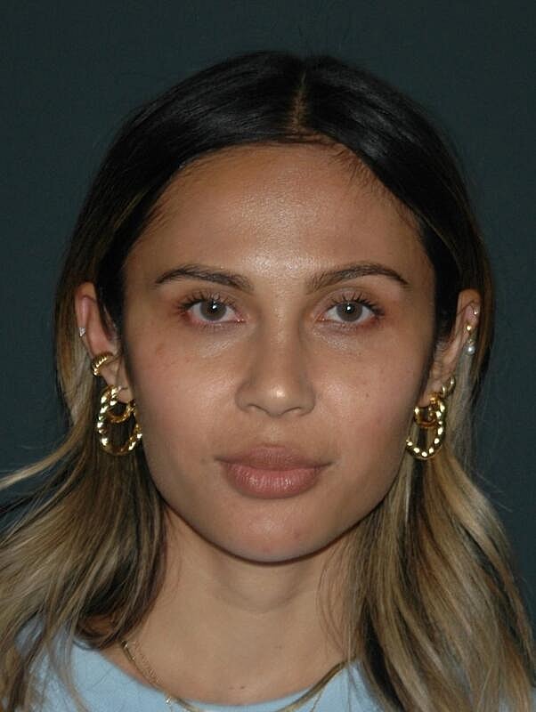 Facelift Before & After