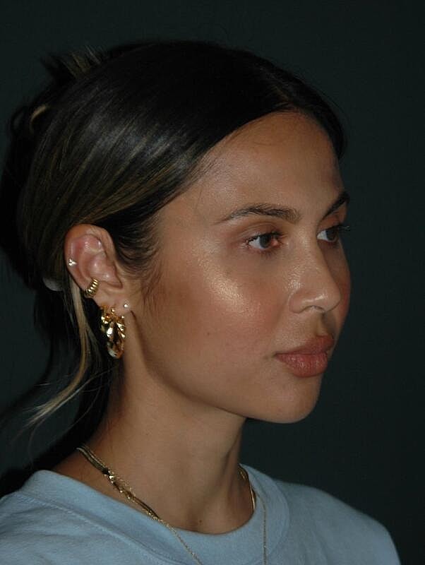 Facelift Before & After