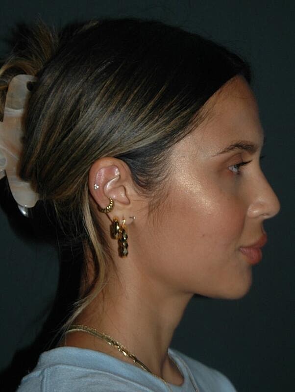 Facelift Before & After
