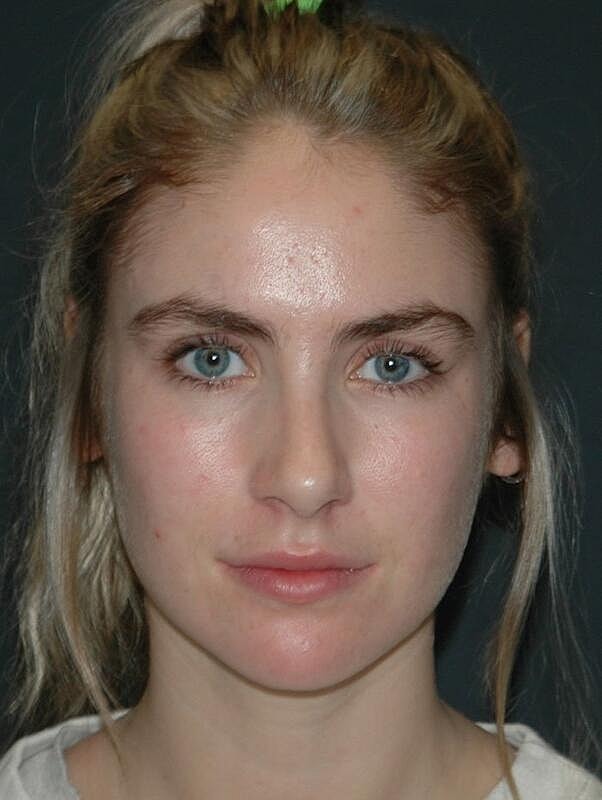 Facelift Before & After