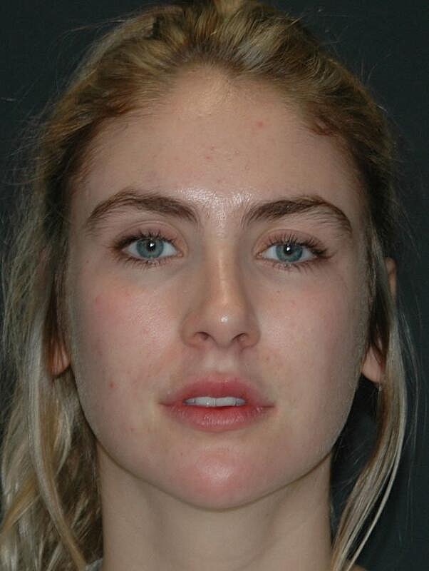 Facelift Before & After