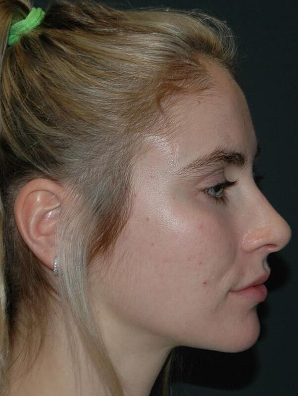 Facelift Before & After