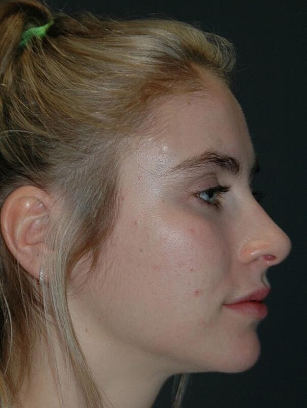 Facelift Before & After