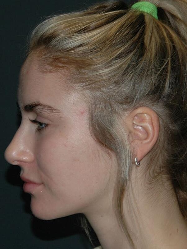 Facelift Before & After