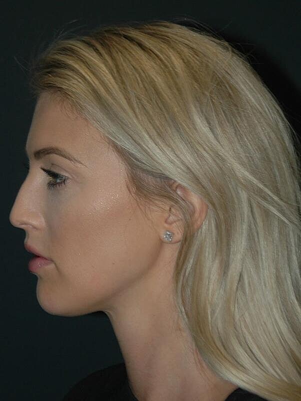 Facelift Before & After