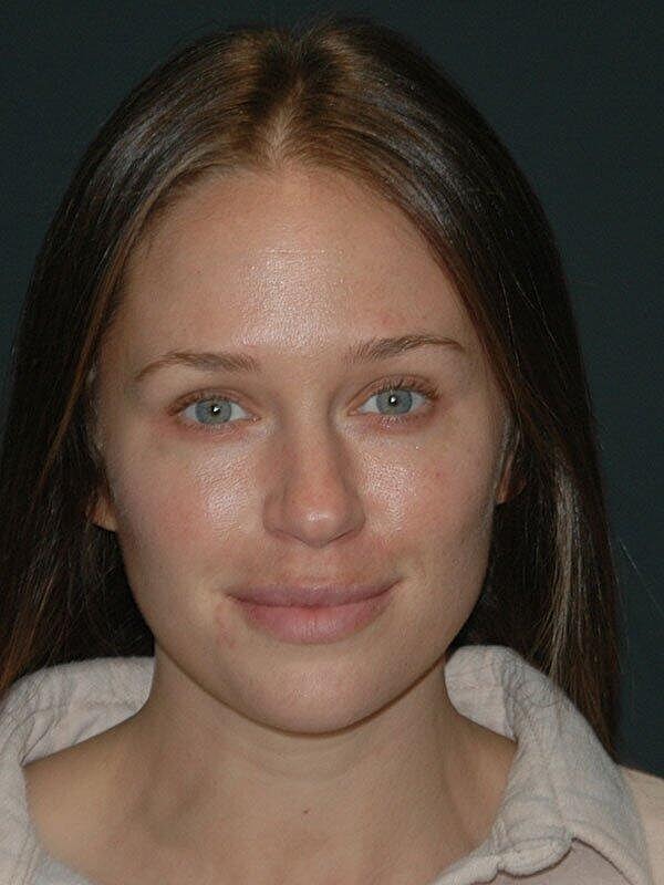 Facelift Before & After