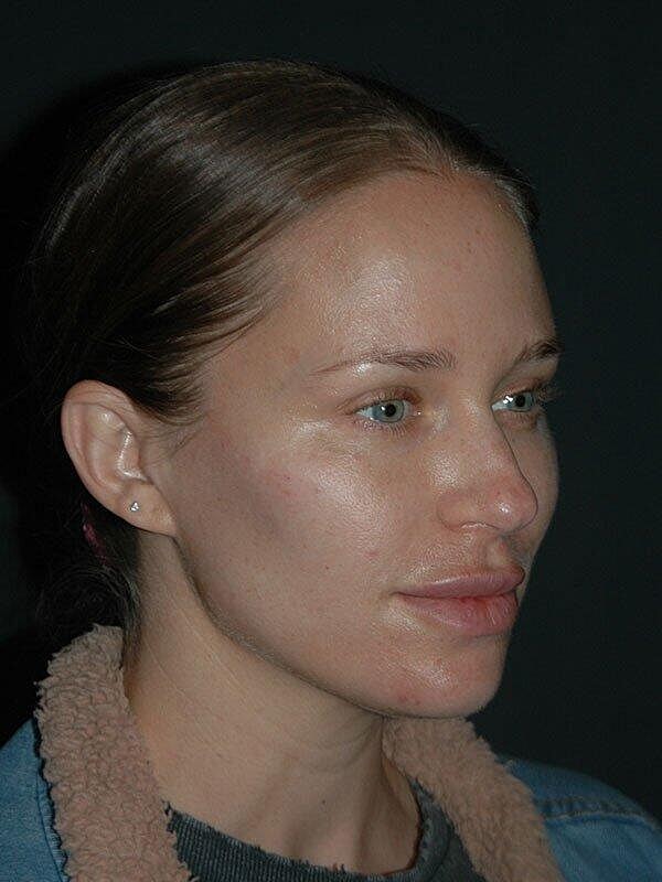 Facelift Before & After