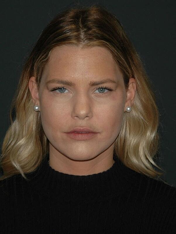 Facelift Before & After