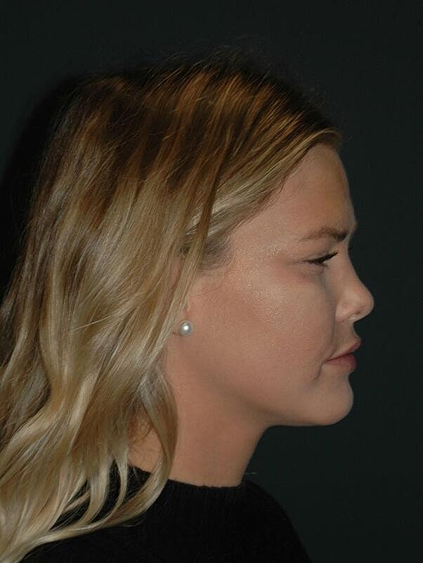 Facelift Before & After
