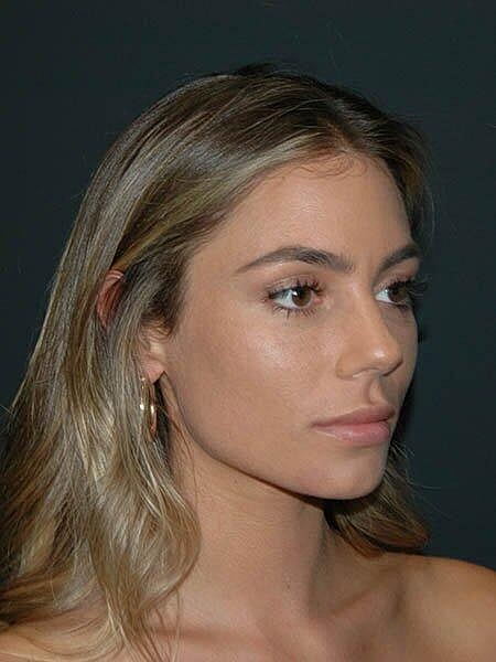 Facelift Before & After