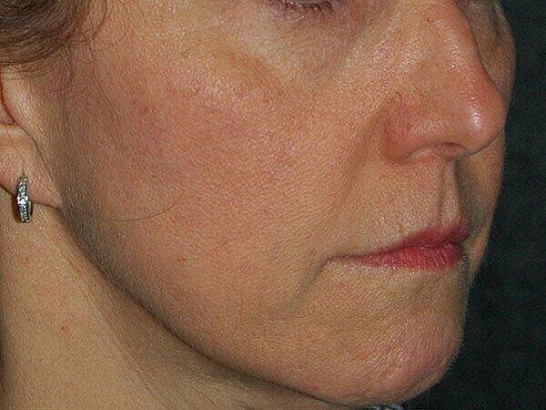 Facelift Before & After