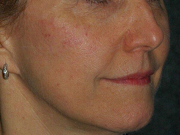 Facelift Before & After
