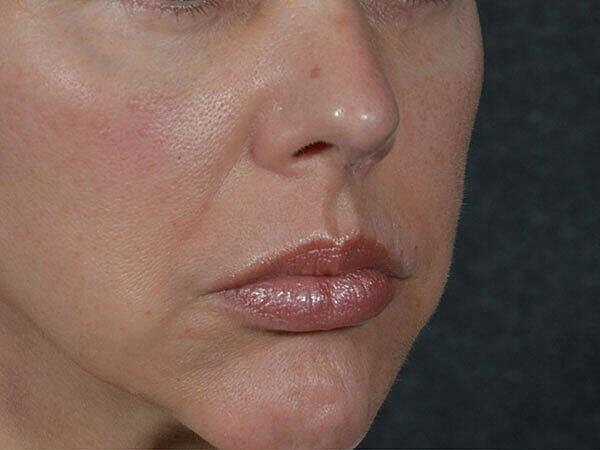 Facelift Before & After