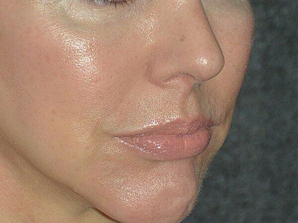 Facelift Before & After