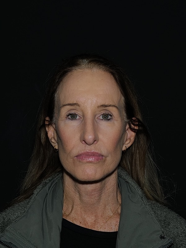 Lip Lift Before & After