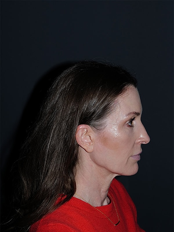 Lip Lift Before & After