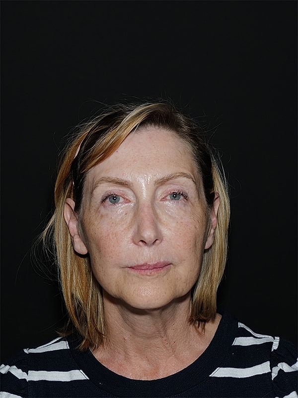 Lip Lift Before & After