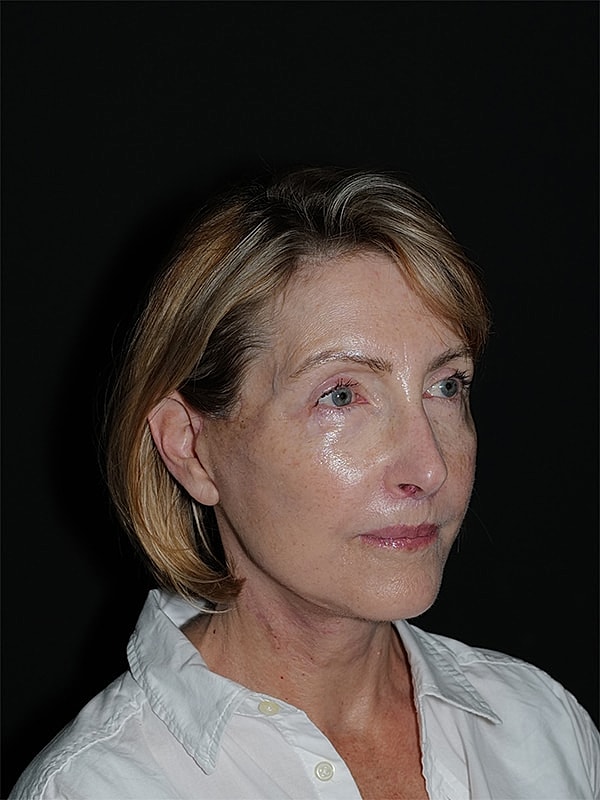 Lip Lift Before & After