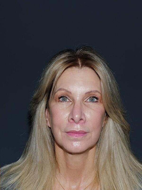 Lip Lift Before & After