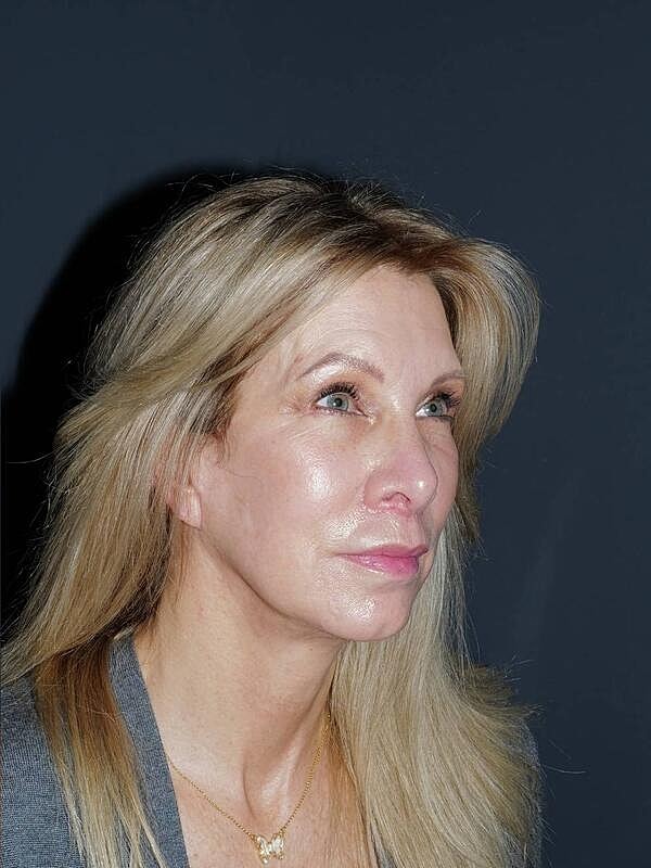 Lip Lift Before & After
