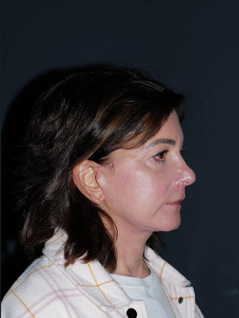 Lip Lift Before & After