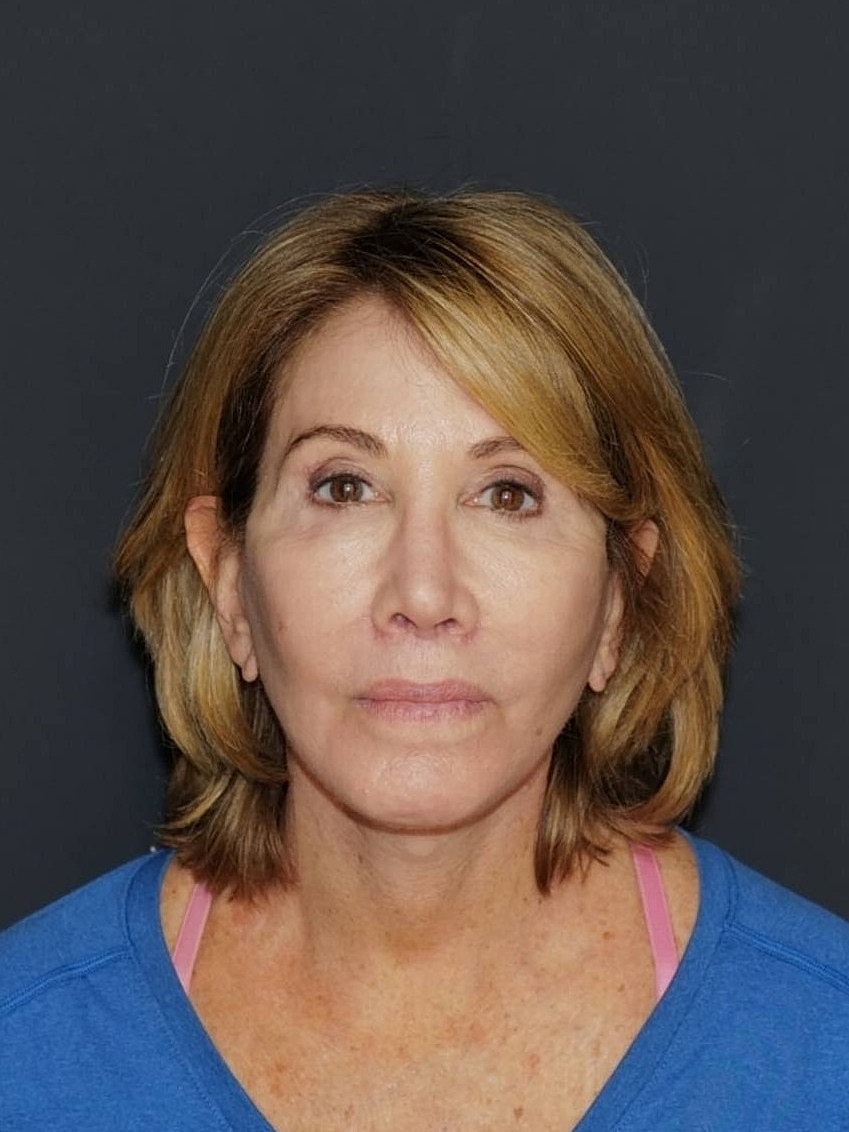 Lip Lift Before & After