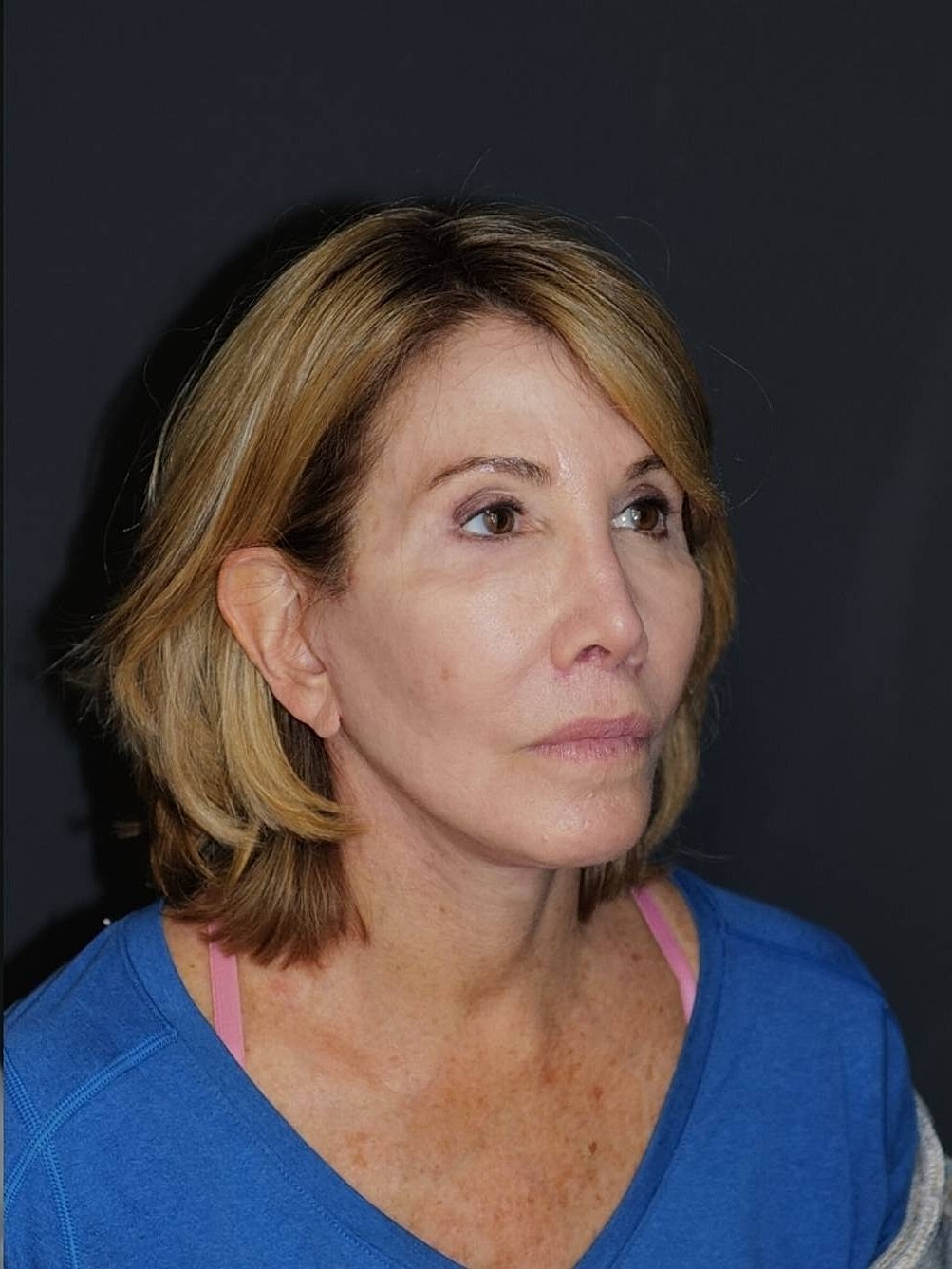 Lip Lift Before & After