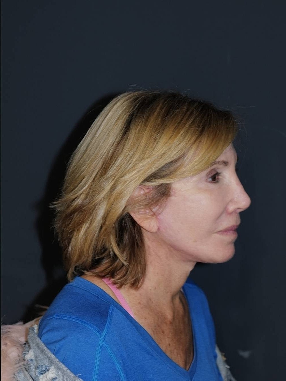 Lip Lift Before & After