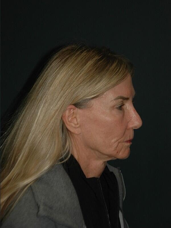 Lip Lift Before & After