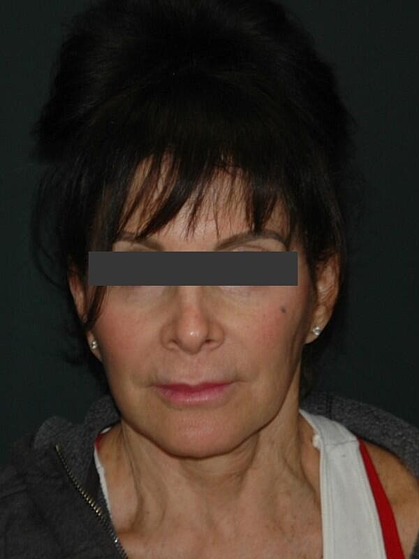 Lip Lift Before & After