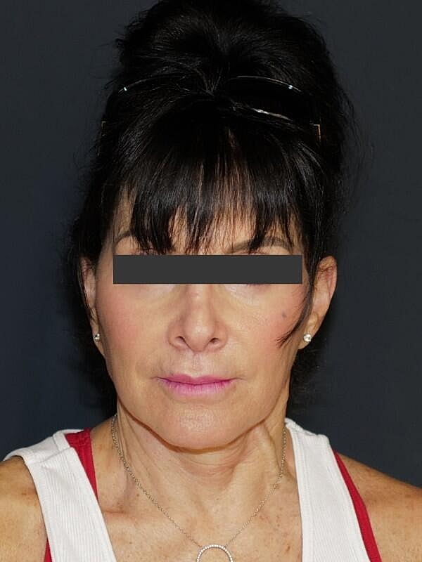Lip Lift Before & After