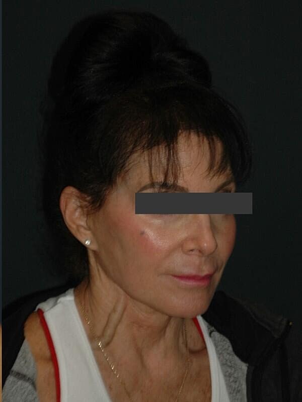 Lip Lift Before & After