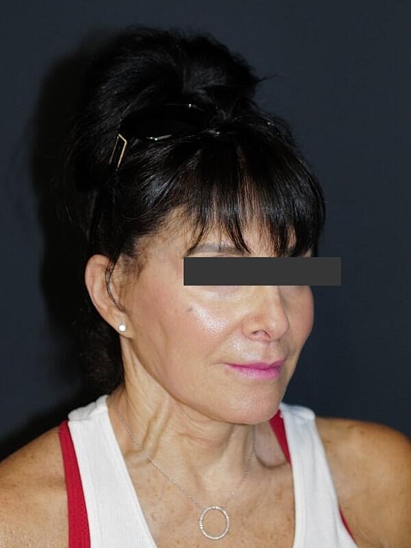 Lip Lift Before & After