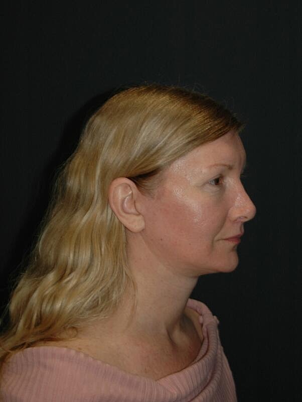 Lip Lift Before & After