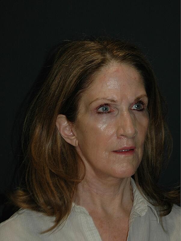 Lip Lift Before & After