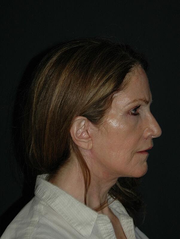 Lip Lift Before & After
