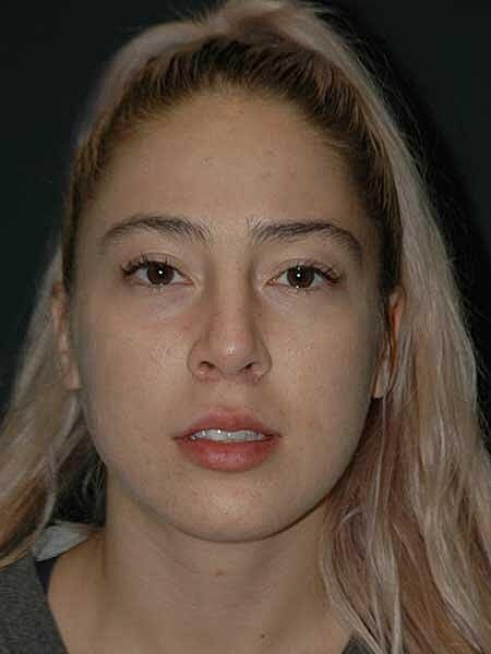 Lip Lift Before & After