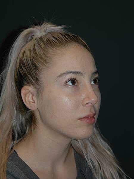 Lip Lift Before & After